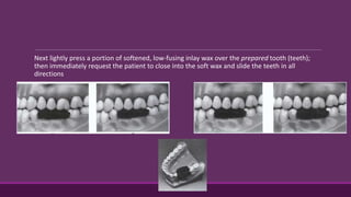 Next lightly press a portion of softened, low-fusing inlay wax over the prepared tooth (teeth);
then immediately request the patient to close into the soft wax and slide the teeth in all
directions
 