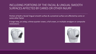 INCLUDING PORTIONS OF THE FACIAL & LINGUAL SMOOTH
SURFACES AFFECTED BY CARIES OR OTHER INJURY
Portion of both a facial/ lingual smooth surface & a proximal surface are affected by caries or
some other factor
A large inlay, an onlay, a three-quarter crown, a full crown, or multiple amalgam or composite
restorations
 