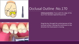 Occlusal Outline :No.170
Initial penetration: Fossa with the edge of the
tip of non dentate tapered fissure bur
Drag the bur through the central groove of the
occlusal surface- leaning the instrument in the
direction the hand piece is moving.
 