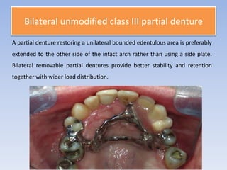 Class iii rpd | PPTX