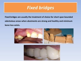 Class iii rpd | PPTX