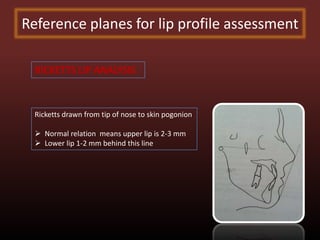 Ricketts Line Class – II malocclusion | PPTX