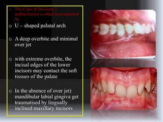 Class – II malocclusion | PPTX