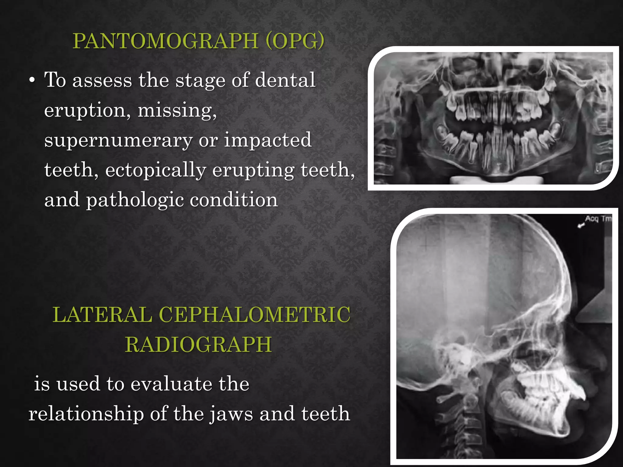 Class ii malocclusion | PPTX