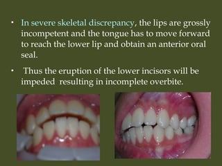  In severe skeletal discrepancy, the lips are grossly
incompetent and the tongue has to move forward
to reach the lower lip and obtain an anterior oral
seal.
 Thus the eruption of the lower incisors will be
impeded resulting in incomplete overbite.
 
