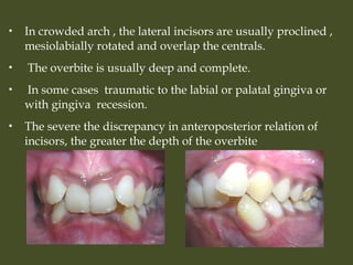  In crowded arch , the lateral incisors are usually proclined ,
mesiolabially rotated and overlap the centrals.
 The overbite is usually deep and complete.
 In some cases traumatic to the labial or palatal gingiva or
with gingiva recession.
 The severe the discrepancy in anteroposterior relation of
incisors, the greater the depth of the overbite
 