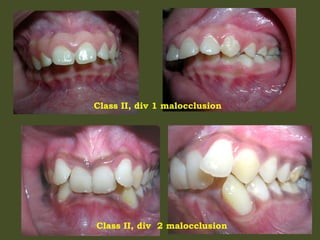 Class II, div 1 malocclusion
Class II, div 2 malocclusion
 