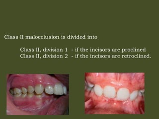 Class II malocclusion