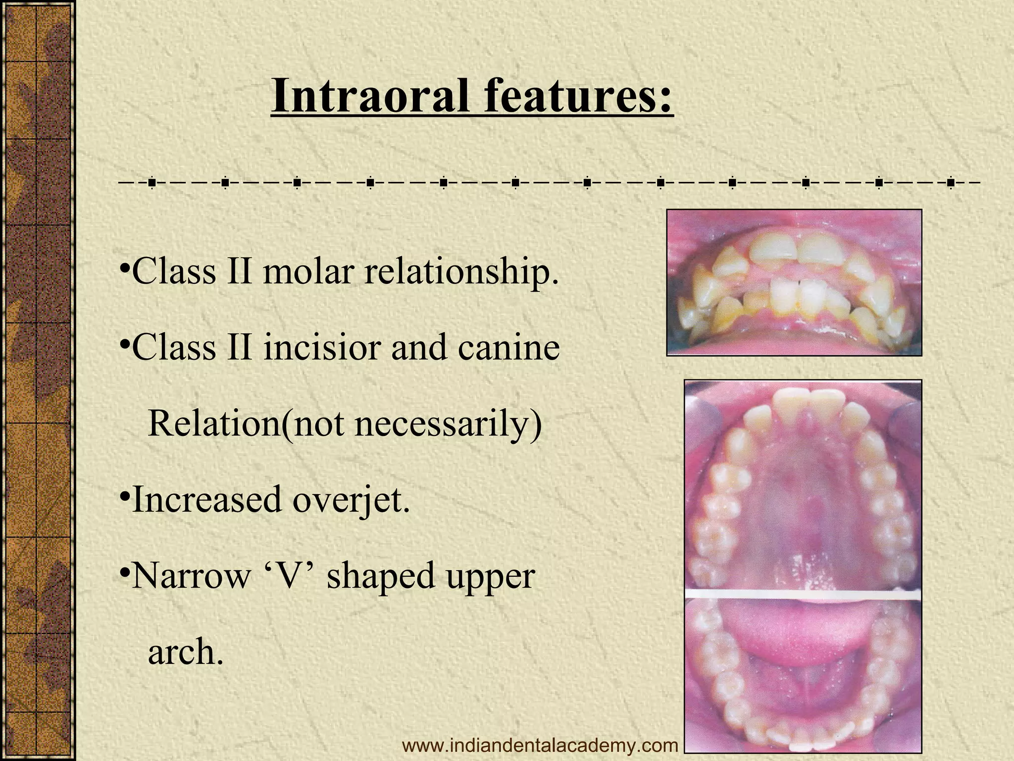 Intraoral features:
•Class II molar relationship.
•Class II incisior and canine
Relation(not necessarily)
•Increased overjet.
•Narrow ‘V’ shaped upper
arch.
www.indiandentalacademy.com

 