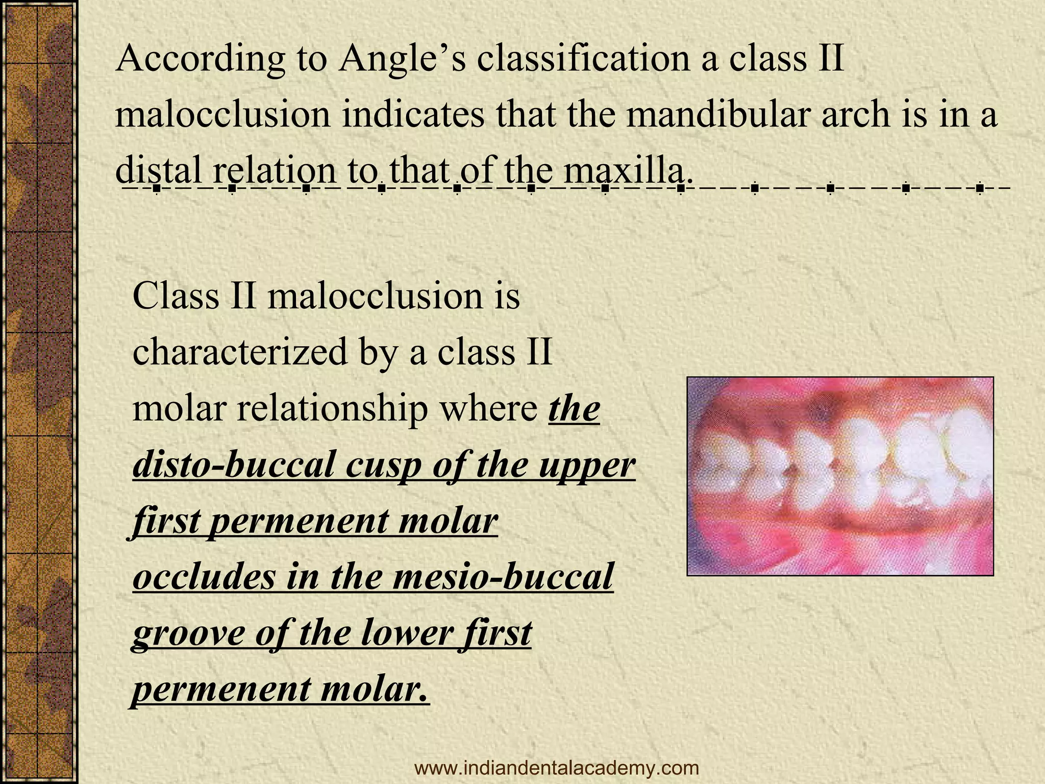 According to Angle’s classification a class II
malocclusion indicates that the mandibular arch is in a
distal relation to that of the maxilla.
Class II malocclusion is
characterized by a class II
molar relationship where the
disto-buccal cusp of the upper
first permenent molar
occludes in the mesio-buccal
groove of the lower first
permenent molar.
www.indiandentalacademy.com

 