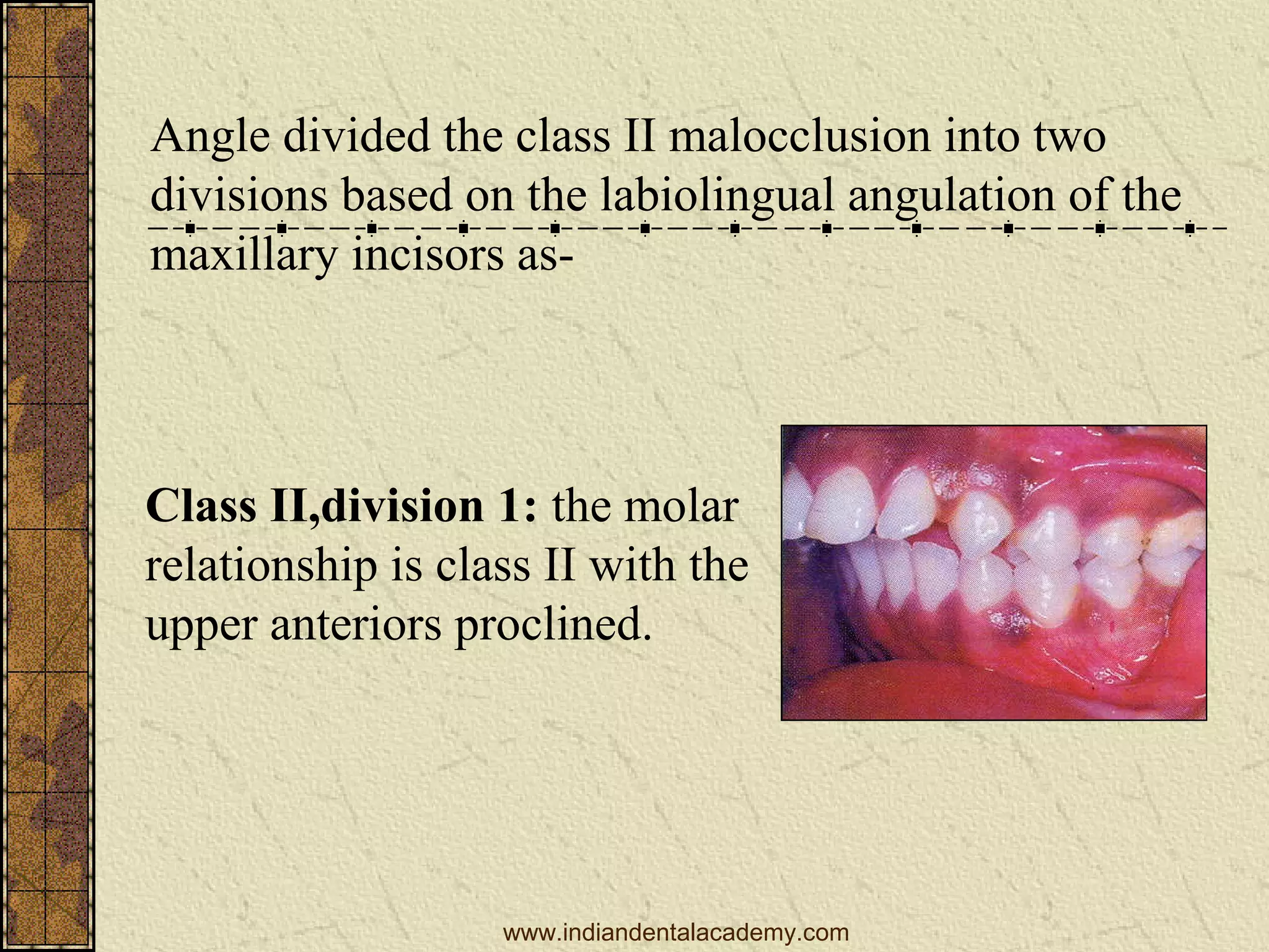 Angle divided the class II malocclusion into two
divisions based on the labiolingual angulation of the
maxillary incisors as-

Class II,division 1: the molar
relationship is class II with the
upper anteriors proclined.

www.indiandentalacademy.com

 