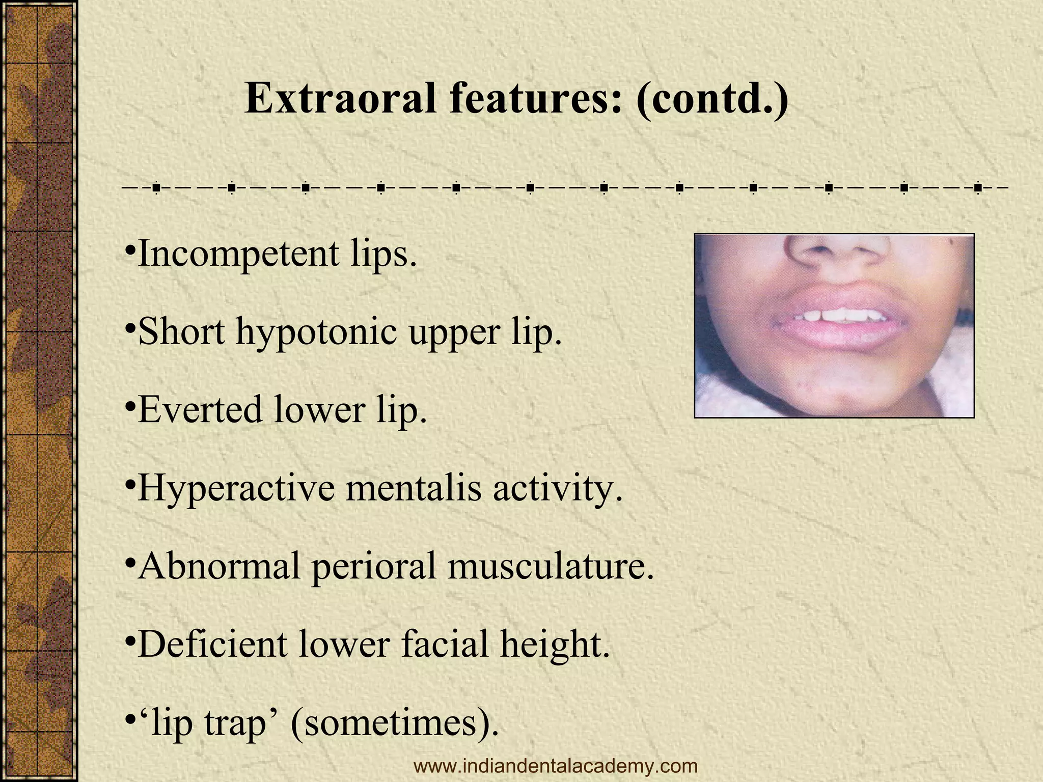 Extraoral features: (contd.)
•Incompetent lips.
•Short hypotonic upper lip.
•Everted lower lip.
•Hyperactive mentalis activity.
•Abnormal perioral musculature.
•Deficient lower facial height.
•‘lip trap’ (sometimes).
www.indiandentalacademy.com

 