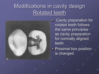 CLASS II tooth prep for SAF.ppt