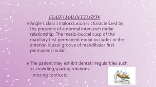  Angle’s class I malocclusion is characterized by
the presence of a normal inter-arch molar
relationship. The mesio-buccal cusp of the
maxillary first permanent molar occludes in the
anterior-buccal groove of mandibular first
permanent molar.
 The patient may exhibit dental irregularities such
as crowding,spacing,rotations,
missing tooth,etc.
 
