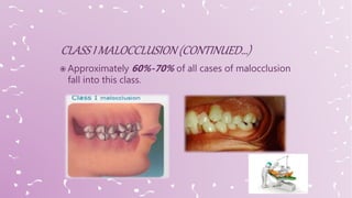  Approximately 60%-70% of all cases of malocclusion
fall into this class.
 