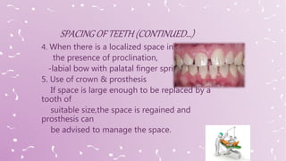 4. When there is a localized space in
the presence of proclination,
-labial bow with palatal finger spring
5. Use of crown & prosthesis
If space is large enough to be replaced by a
tooth of
suitable size,the space is regained and
prosthesis can
be advised to manage the space.
 