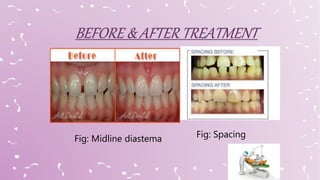 Fig: Midline diastema Fig: Spacing
 