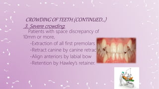 3. Severe crowding:
Patients with space discrepancy of
10mm or more,
-Extraction of all first premolars
-Retract canine by canine retractor
-Align anteriors by labial bow
-Retention by Hawley’s retainer.
 