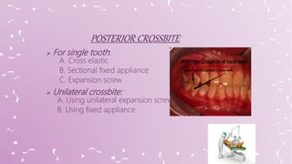  For single tooth:
A. Cross elastic
B. Sectional fixed appliance
C. Expansion screw
 Unilateral crossbite:
A. Using unilateral expansion screw
B. Using fixed appliance
 