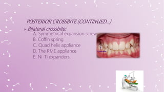  Bilateral crossbite:
A. Symmetrical expansion screw
B. Coffin spring
C. Quad helix appliance
D. The RME appliance
E. Ni-Ti expanders.
 