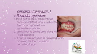 Posterior openbite
1. If it is due to lateral tongue thrust
habit,use of lateral tongue spike either
fixed or incorporated in a
removable appliance
2. Vertical elastic can be used along with
fixed appliance
3. If due to infra occlusion of ankylosed tooth,
crown on the tooth to restore
normal occlusion.
 