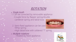  Single tooth
1. Can be corrected by removable appliance
-Couple force by flapper spring/double
cantilever spring and labial bow
2. Semi-fixed appliance can be used
-Whip spring
-High labial bow with soldered ‘T’ spring.
 Multiple rotations
-Treated by fixed appliance.
 