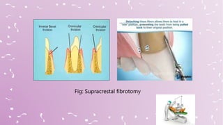 Fig: Supracrestal fibrotomy
 