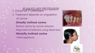 1. Extract all 1st premolars
2. Treatment depends on angulation
of canine
-Distally inclined canine
Retract canine by canine retractor
Alignment of anteriors using labial bow
-Mesially inclined canine
Fixed appliance.
 