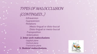 -Infraversion
-Supraversion
-Rotations
.Mesio-lingual or disto-buccal
.Disto-lingual or mesio-buccal
-Transposition
-Imbrication
2. Inter-arch malocclusions
-Sagittal plane
-Vertical plane
-Transverse plane
3. Skeletal malocclusions.
 