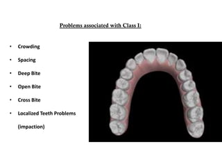 Problems associated with Class I:
• Crowding
• Spacing
• Deep Bite
• Open Bite
• Cross Bite
• Localized Teeth Problems
(impaction)
 