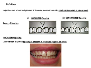 Imperfections in teeth alignment & distance, wherein there is gap b/w two teeth or many teeth
Definition
Types of Spacing
LOCALIZED Spacing
A condition in which Spacing is present in localised regions or areas
(i) LOCALIZED Spacing (ii) GENERALIZED Spacing
 
