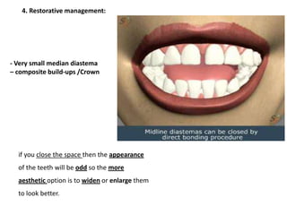 - Very small median diastema
– composite build-ups /Crown
4. Restorative management:
if you close the space then the appearance
of the teeth will be odd so the more
aesthetic option is to widen or enlarge them
to look better.
 