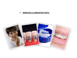  IMPACTED or UNERUPTED TEETH.
 