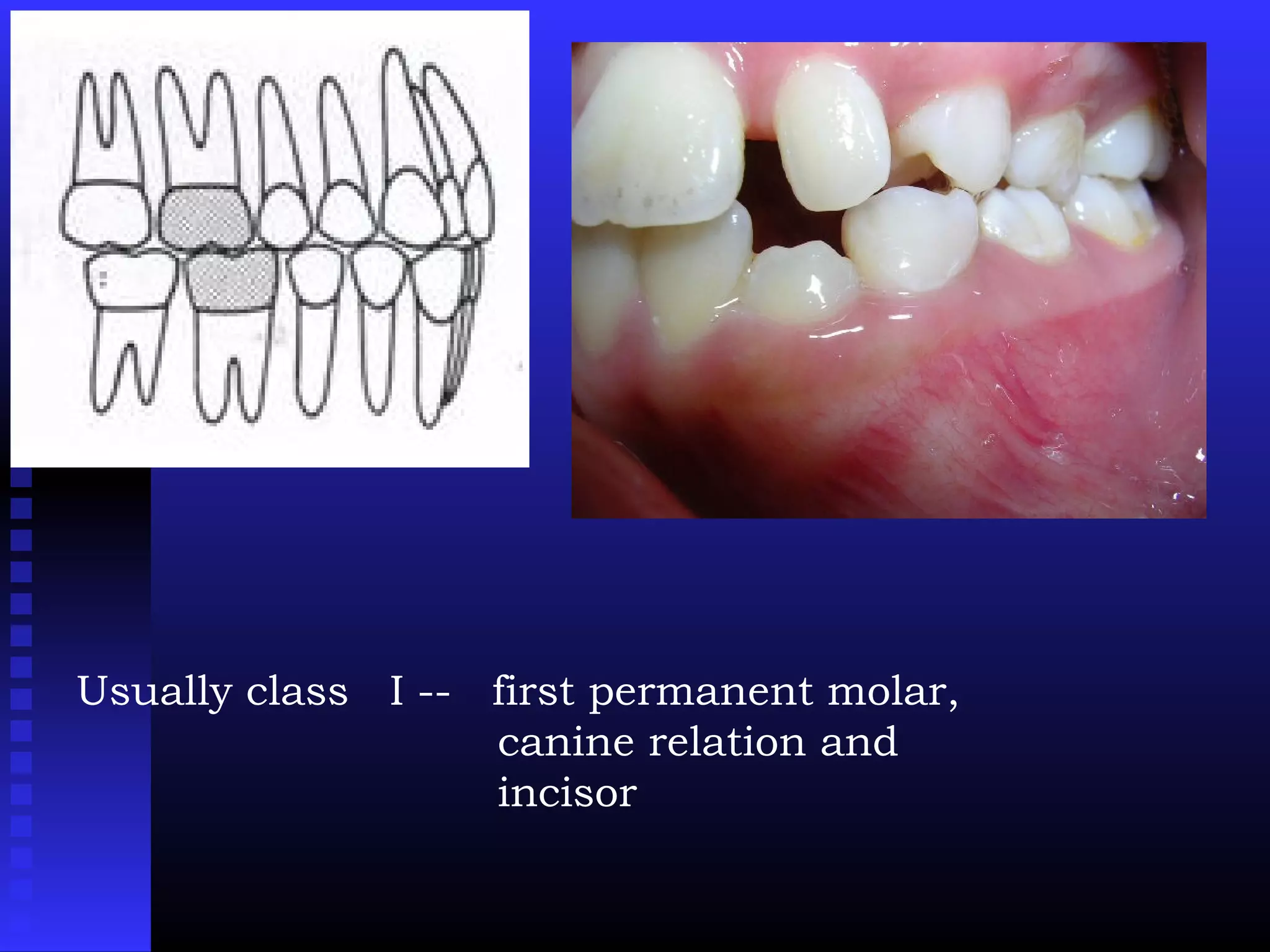 Usually class I -- first permanent molar,
canine relation and
incisor
 