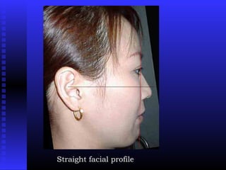 Straight facial profile
 