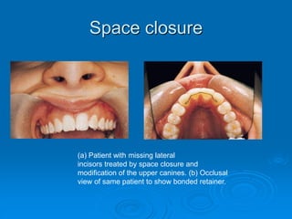 Space closure
(a) Patient with missing lateral
incisors treated by space closure and
modification of the upper canines. (b) Occlusal
view of same patient to show bonded retainer.
 
