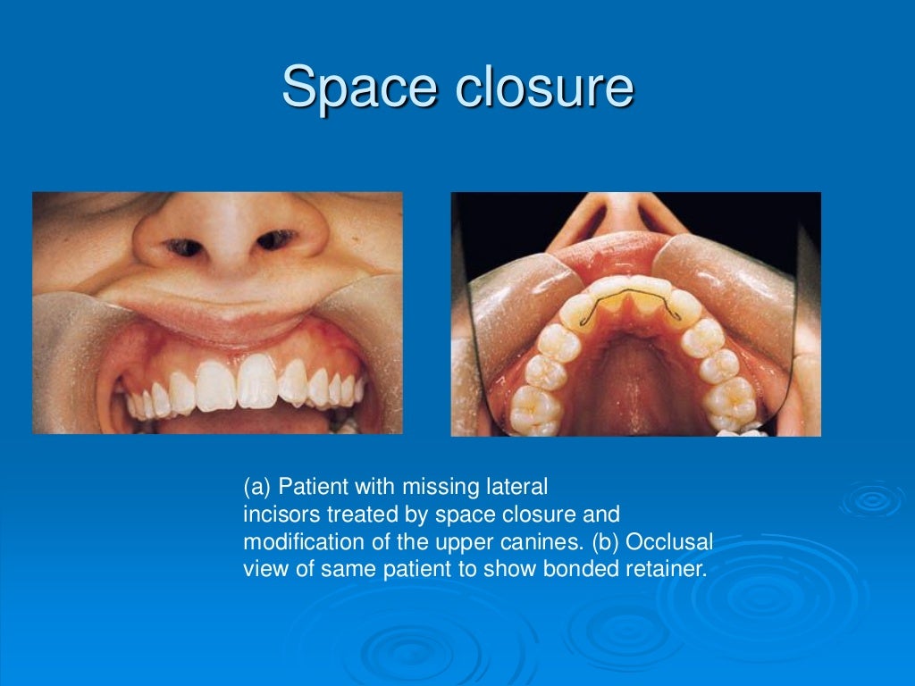 Class i orthodontics Dentistry