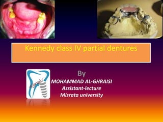 Kennedy class IV partial dentures
By
MOHAMMAD AL-GHRAISI
Assistant-lecture
Misrata university
 