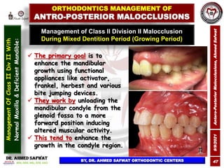 9/9/2021
Antero-Posterior
Malocclusions,
Ahmed
Safwat
47
Management of Class II Division II Malocclusion
During Mixed Dent...