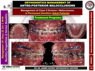 9/9/2021
Antero-Posterior
Malocclusions,
Ahmed
Safwat
73
Management of Class II Division I Malocclusion
In Permanent Denti...