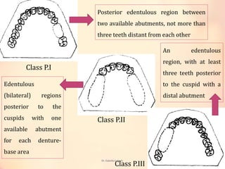 Edentulous Class Rpd Classification systems for partially edentulous arches | PPTX