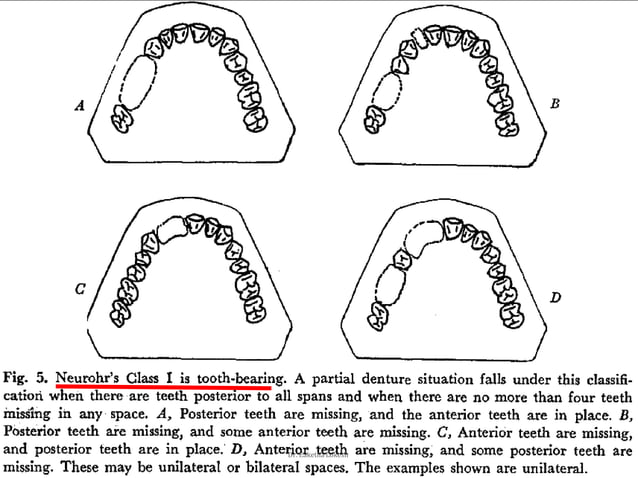 Classification systems for partially edentulous arches | PPTX | Dental ...