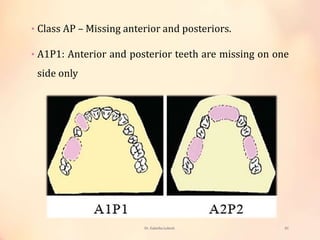 Classification systems for partially edentulous arches | PPTX
