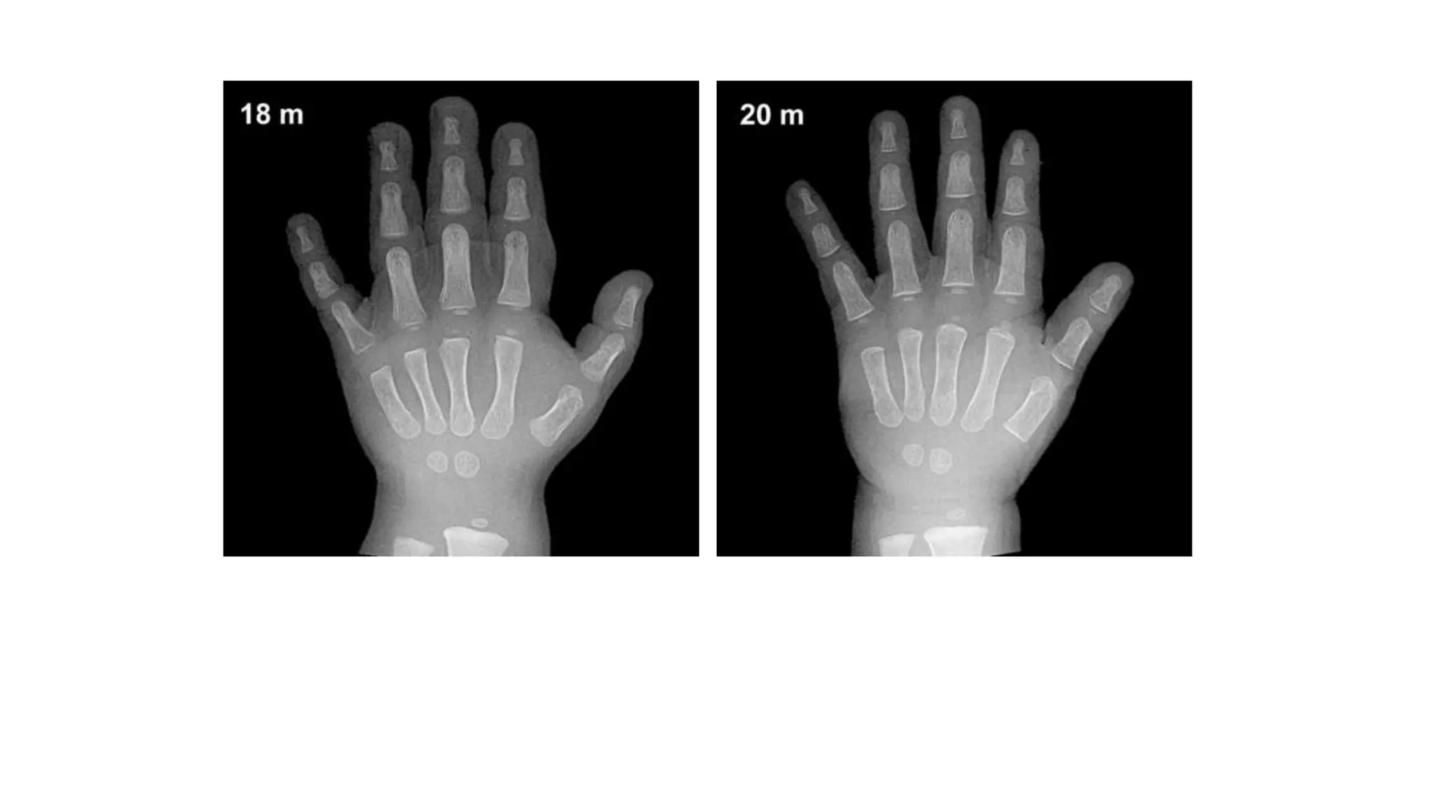 BONE AGE ESTIMATION | PDF