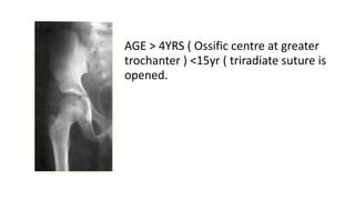 AGE > 4YRS ( Ossific centre at greater
trochanter ) <15yr ( triradiate suture is
opened.
 