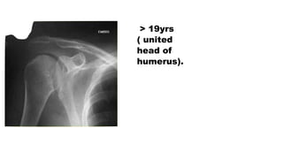 > 19yrs
( united
head of
humerus).
 