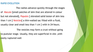 RAPID EVOLUTION
The rashes advance quickly through the stages
of Macule [small patches of skin that are altered in colour
but not elevated], Papules [ elevated solid lesion of skin less
than 1 cm ] Vesicles[ a thin-walled sac filled with a fluid,
usually clear and small less than 1 cm ] with in 24 hours.
The vesicles may form a crust without going
to pustular stage. Usually, they are superficial in site ,with
easily ruptured wall
 