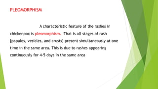 PLEOMORPHISM
A characteristic feature of the rashes in
chickenpox is pleomorphism. That is all stages of rash
[papules, vesicles, and crusts] present simultaneously at one
time in the same area. This is due to rashes appearing
continuously for 4-5 days in the same area
 