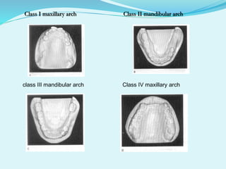 Class I maxillary arch Class II mandibular arch
class III mandibular arch Class IV maxillary arch
 