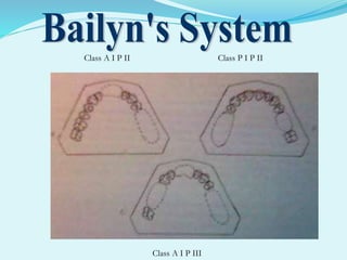 Class A I P II Class P I P II
Class A I P III
 